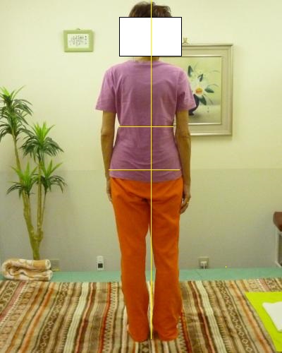 慢性の腰部の姿形写真